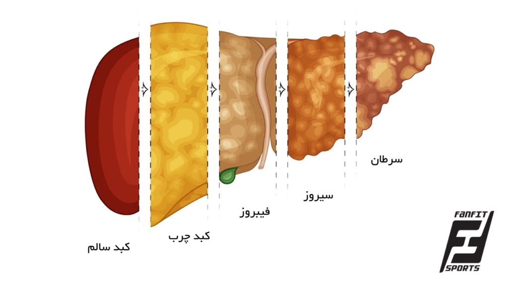 پیوستار پیشرفت بیماری کبد چرب 